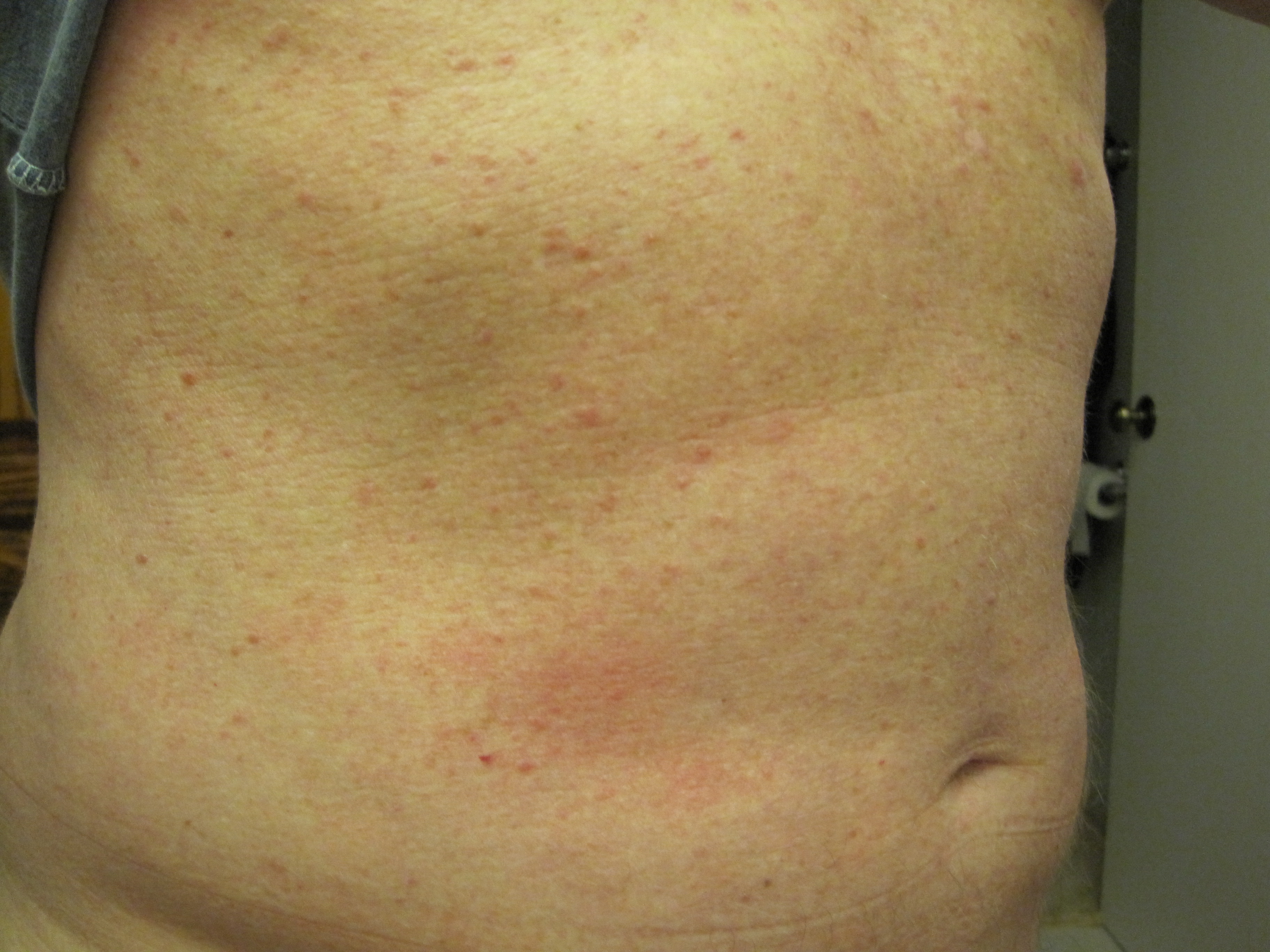 Skin Rash During Chronic Hepatitis C Therapy